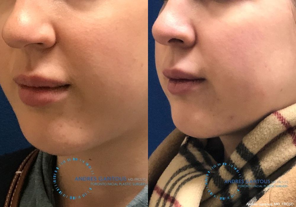 Chin Augmentation - Thumbnail 2