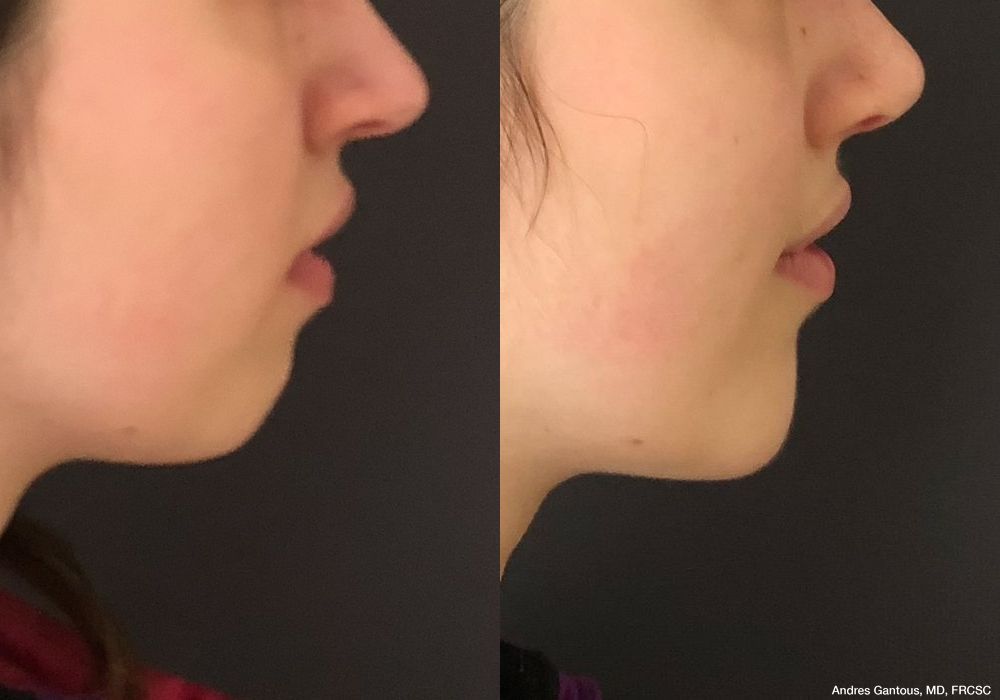 Chin Augmentation - Thumbnail 3