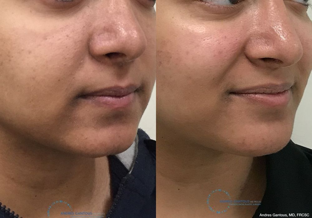 Chin Augmentation - Thumbnail 2