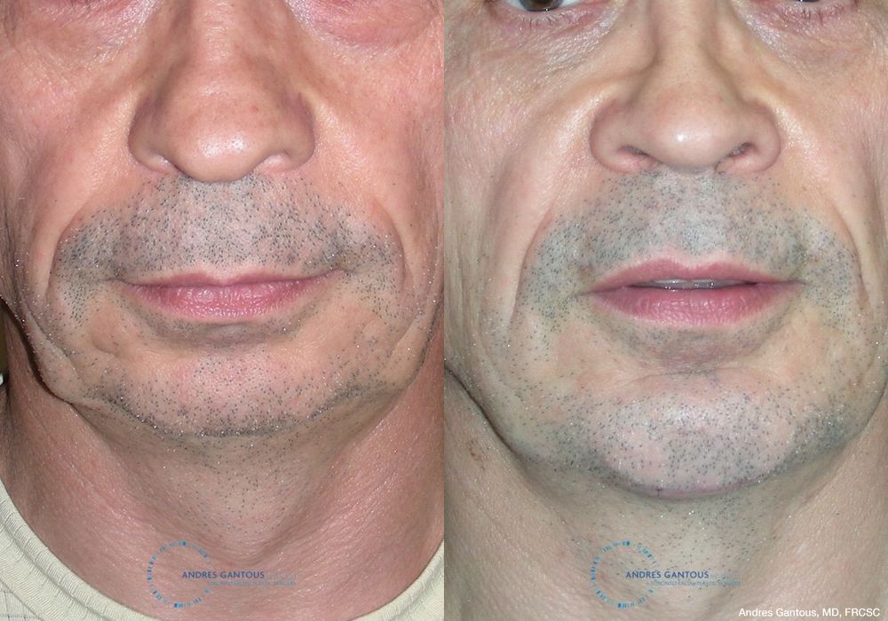 Chin Augmentation - Case 6598