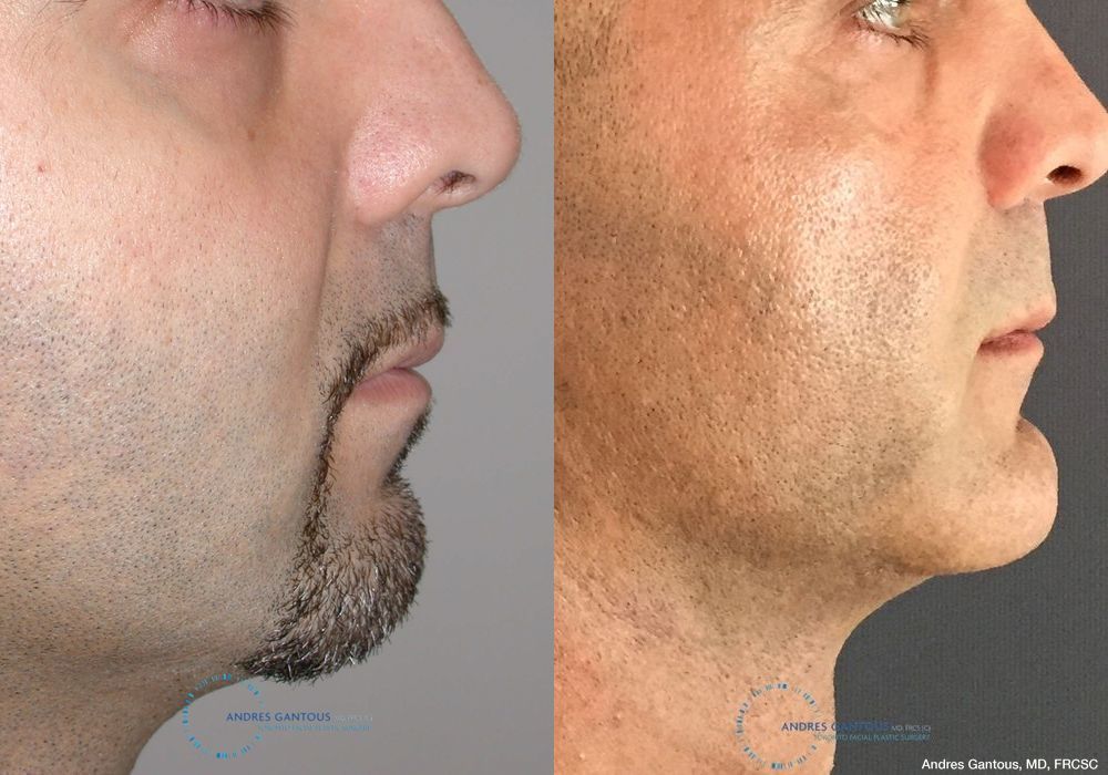 Chin Augmentation - Thumbnail 3
