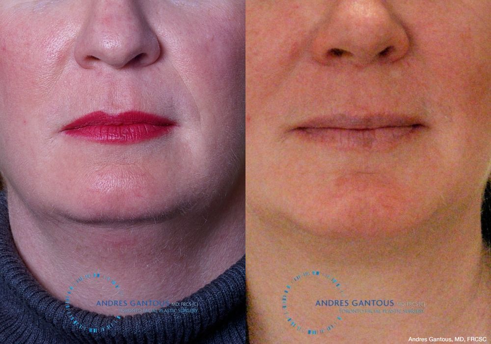 Chin Augmentation - Case 6604