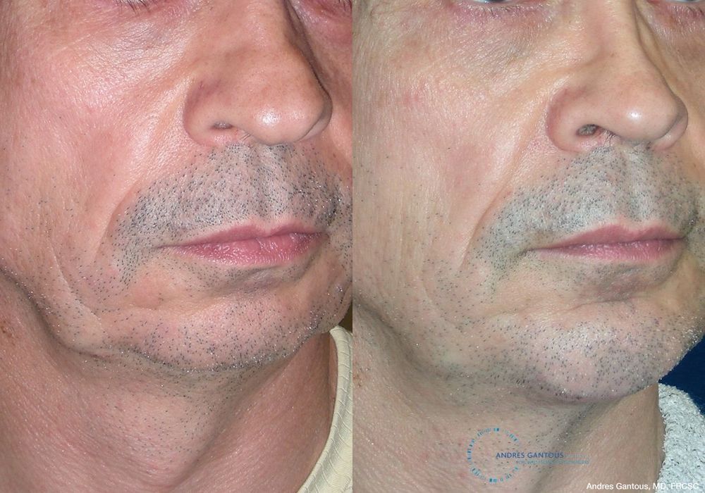 Chin Augmentation - Thumbnail 2