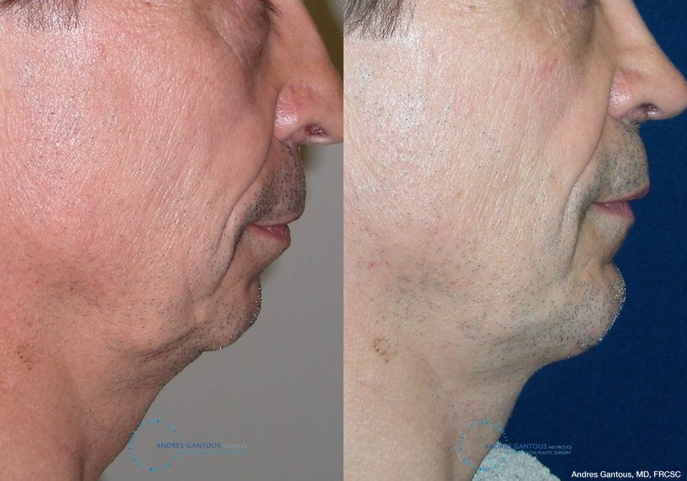 Chin Augmentation - Thumbnail 3