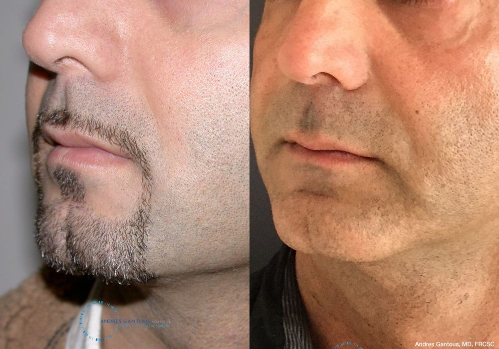 Chin Augmentation - Thumbnail 2