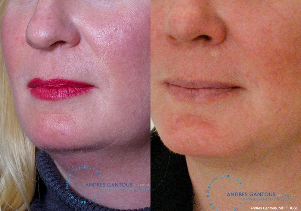 Chin Augmentation - Thumbnail 2