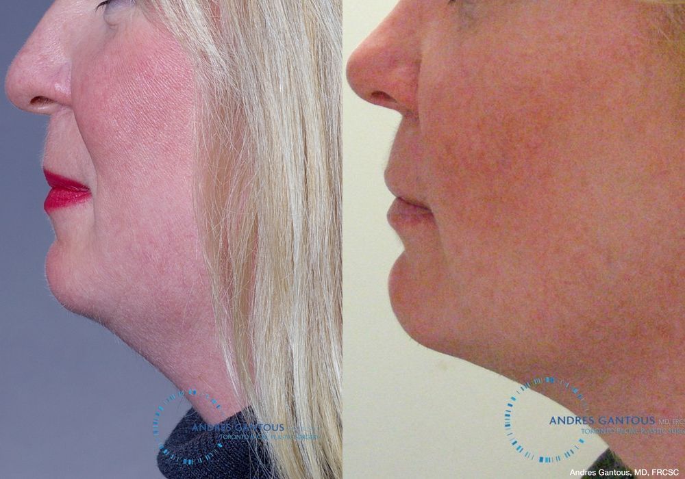 Chin Augmentation - Thumbnail 3