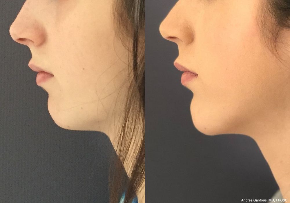 Chin Augmentation - Thumbnail 2