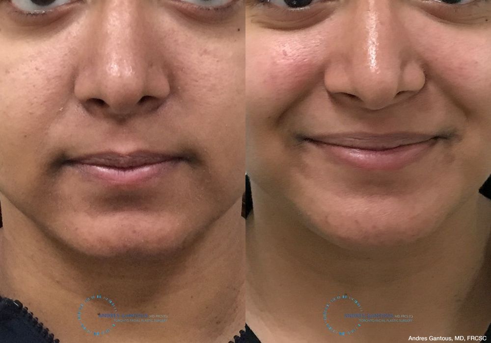 Chin Augmentation - Case 6599