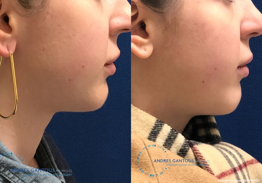 Chin Augmentation - Thumbnail 3