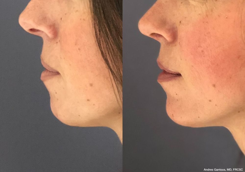 Chin Augmentation - Thumbnail 2