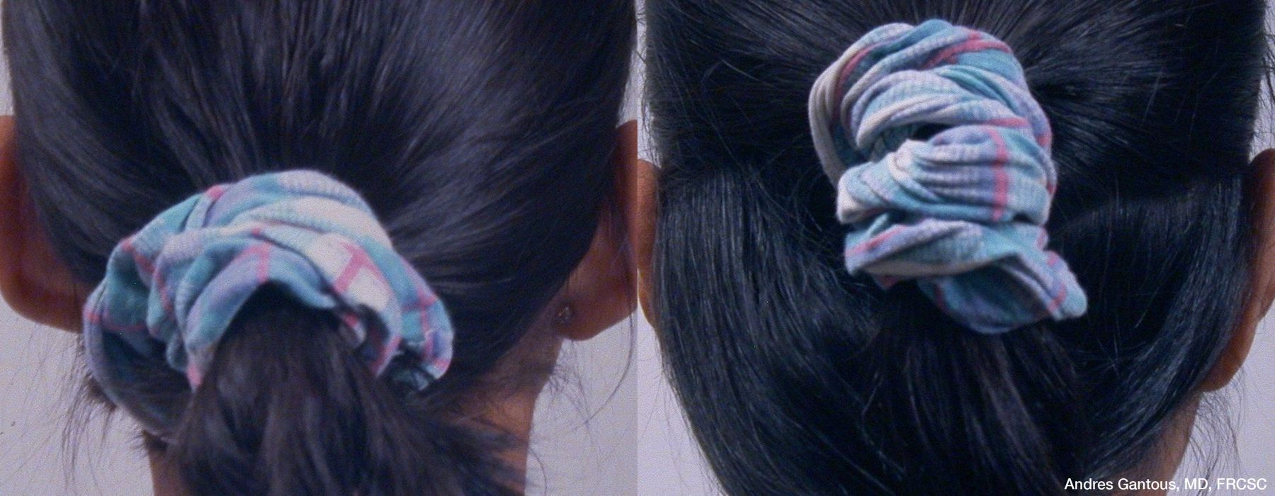 Otoplasty and Earlobe Repair - Thumbnail 6