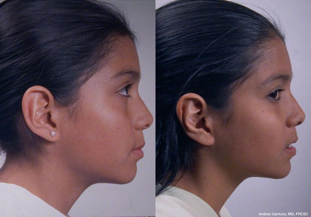 Otoplasty and Earlobe Repair - Thumbnail 3