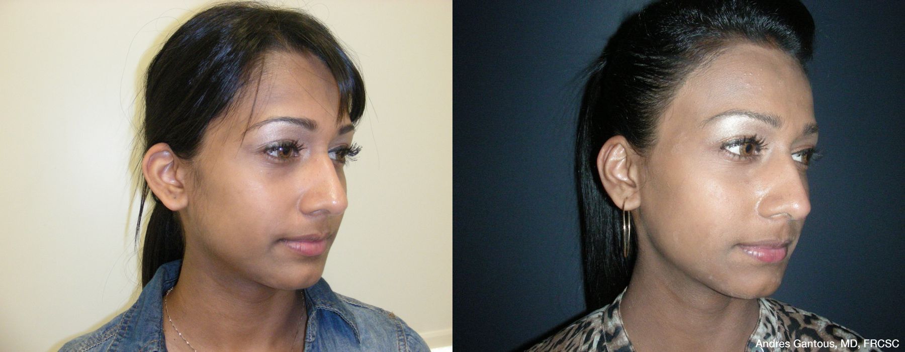 Otoplasty and Earlobe Repair - Thumbnail 2