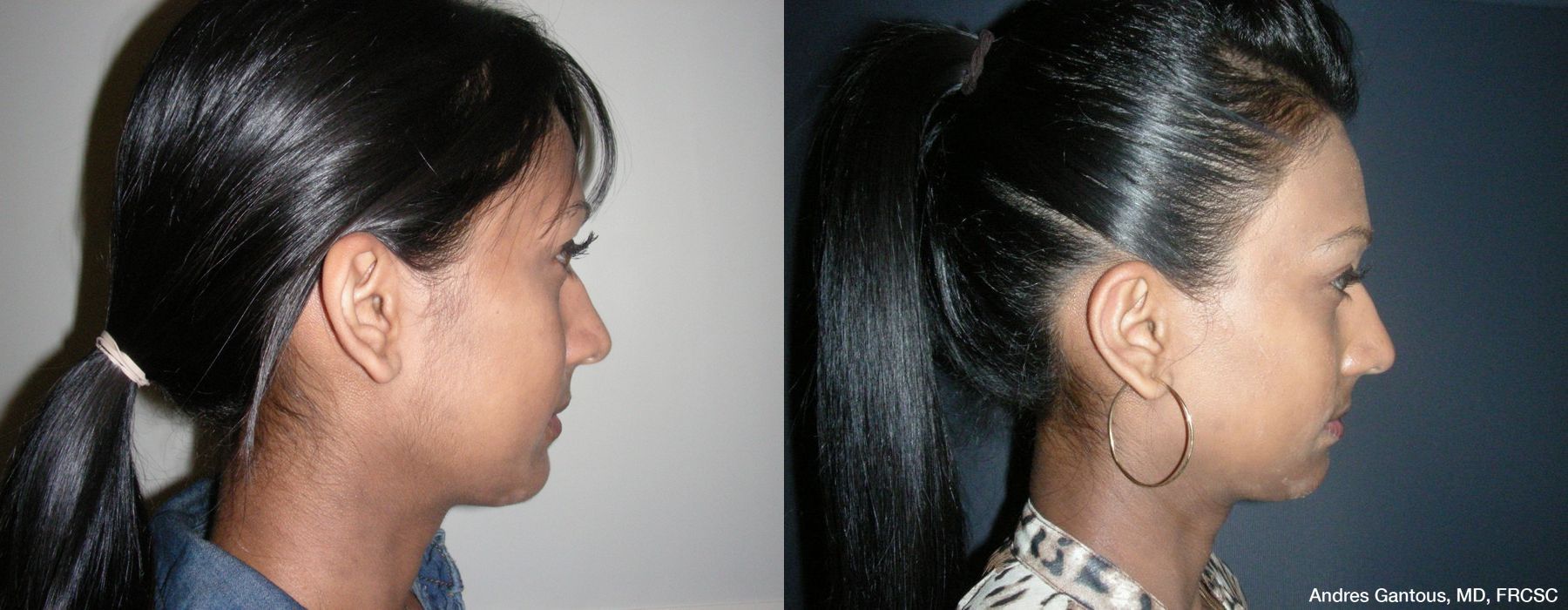 Otoplasty and Earlobe Repair - Thumbnail 3