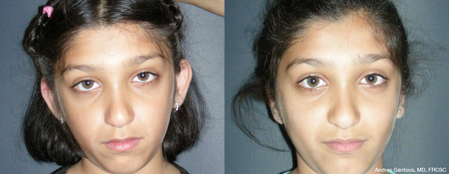 Otoplasty and Earlobe Repair - Case 6988