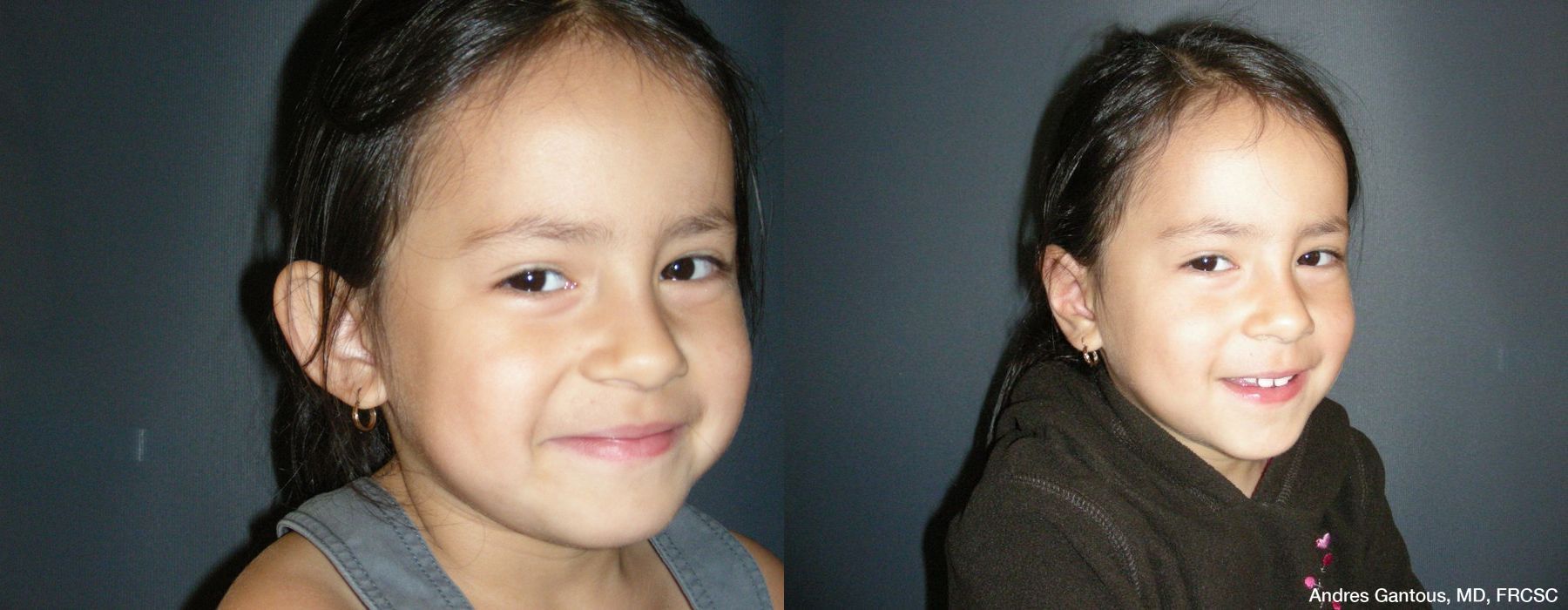 Otoplasty and Earlobe Repair - Thumbnail 2