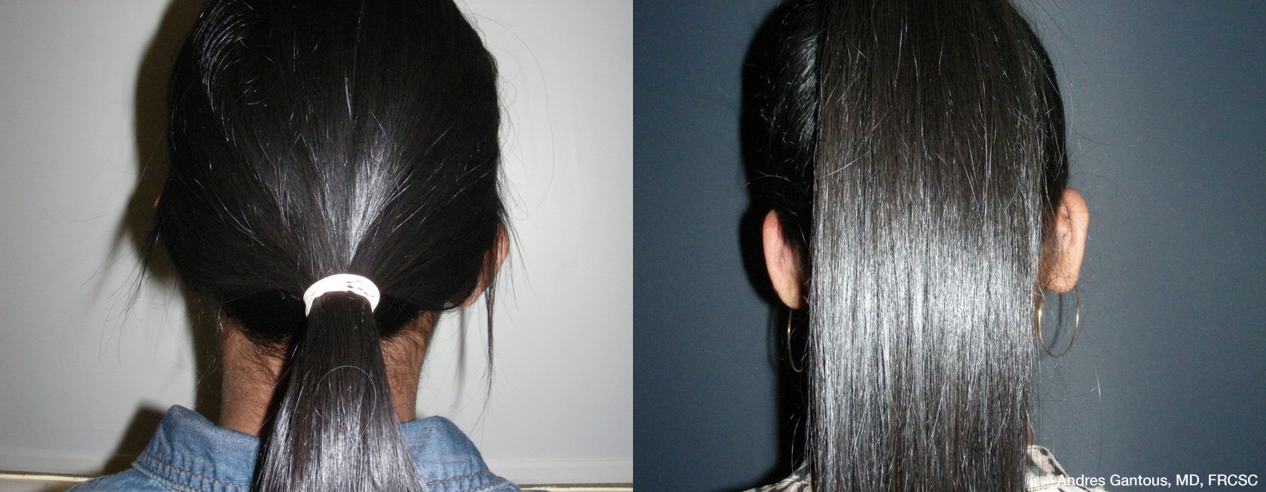 Otoplasty and Earlobe Repair - Thumbnail 4