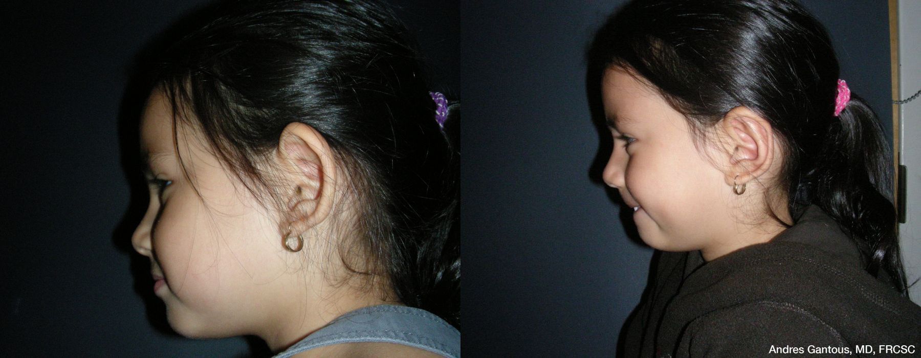 Otoplasty and Earlobe Repair - Thumbnail 5