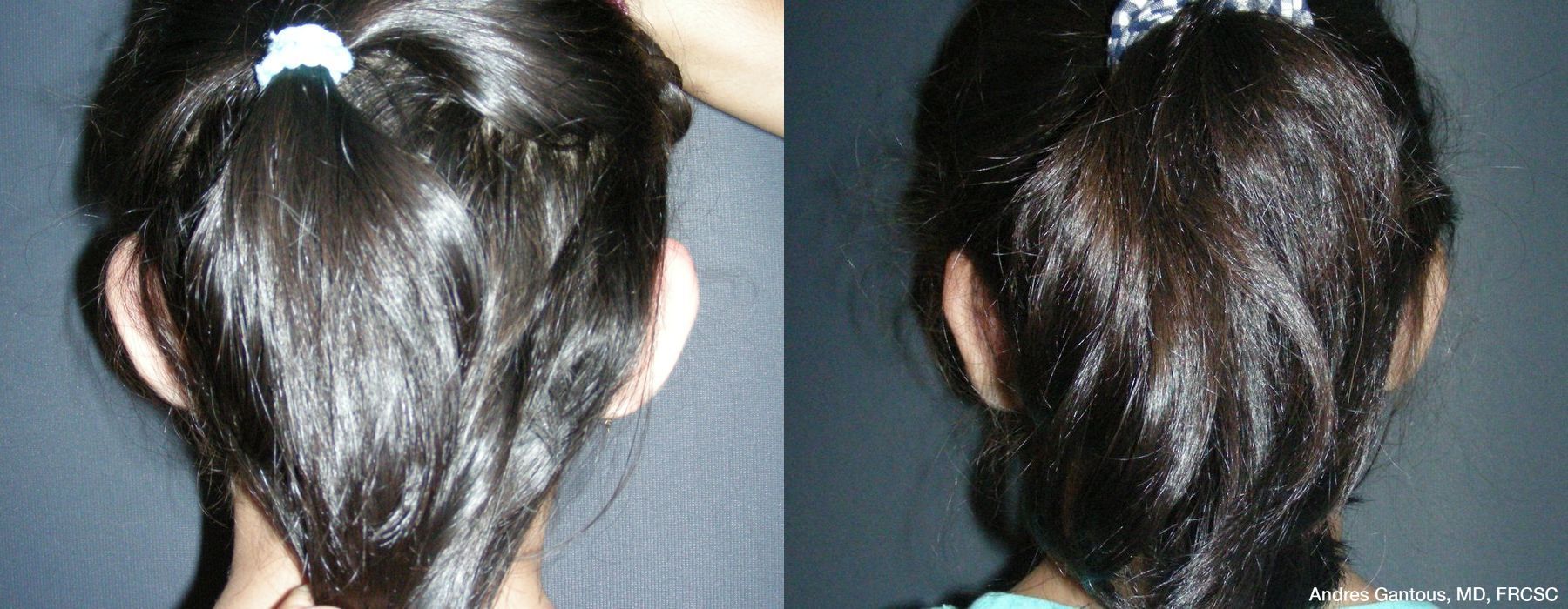 Otoplasty and Earlobe Repair - Thumbnail 2