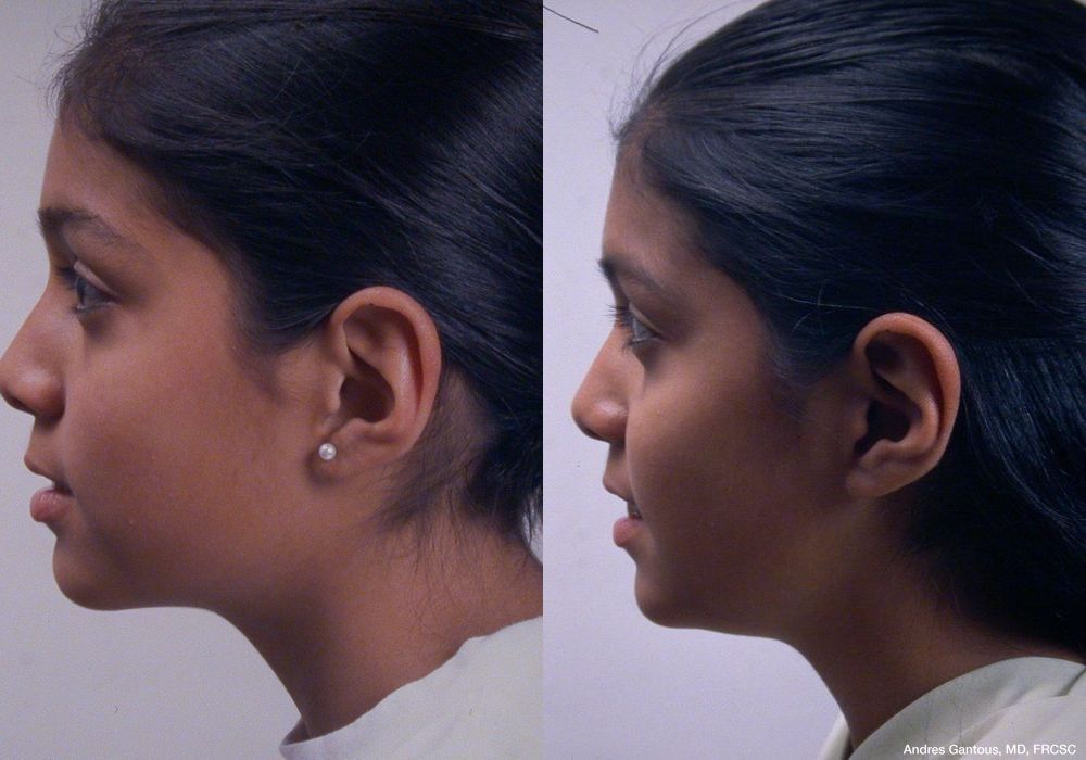 Otoplasty and Earlobe Repair - Thumbnail 5