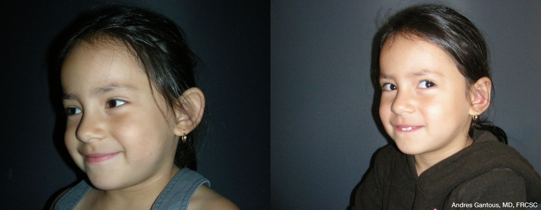 Otoplasty and Earlobe Repair - Thumbnail 4