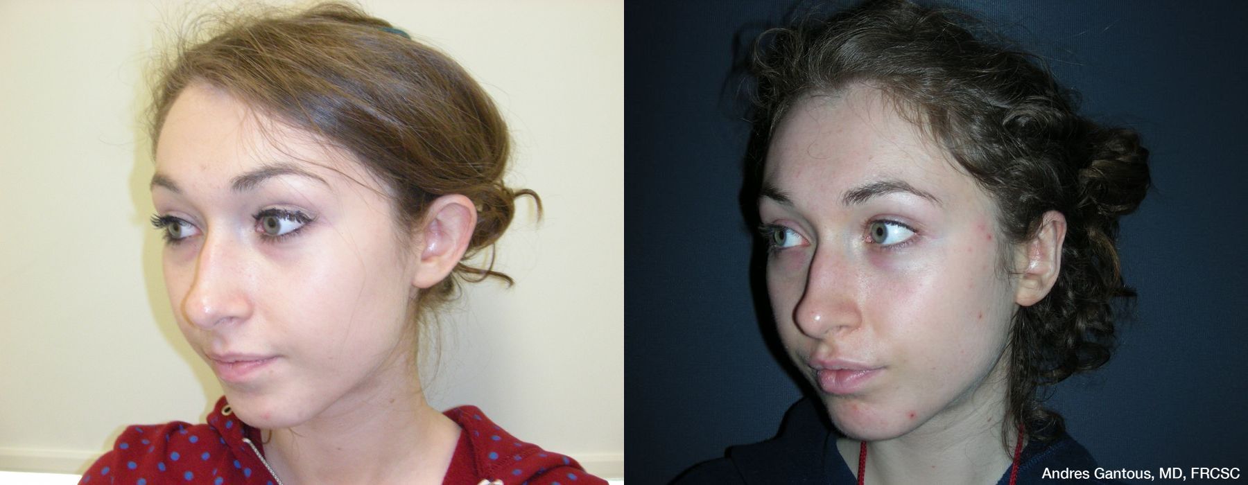 Otoplasty and Earlobe Repair - Thumbnail 4