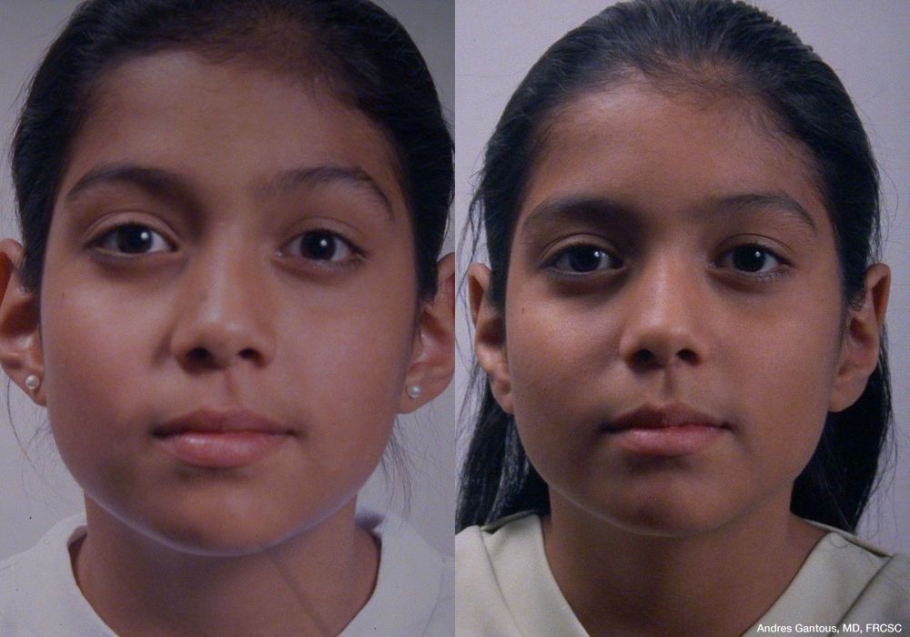 Otoplasty and Earlobe Repair - Case 6995