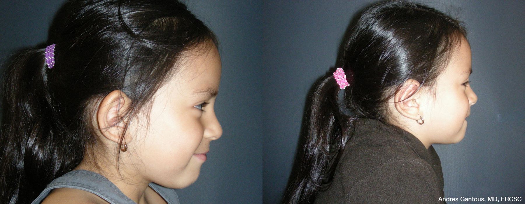 Otoplasty and Earlobe Repair - Thumbnail 3