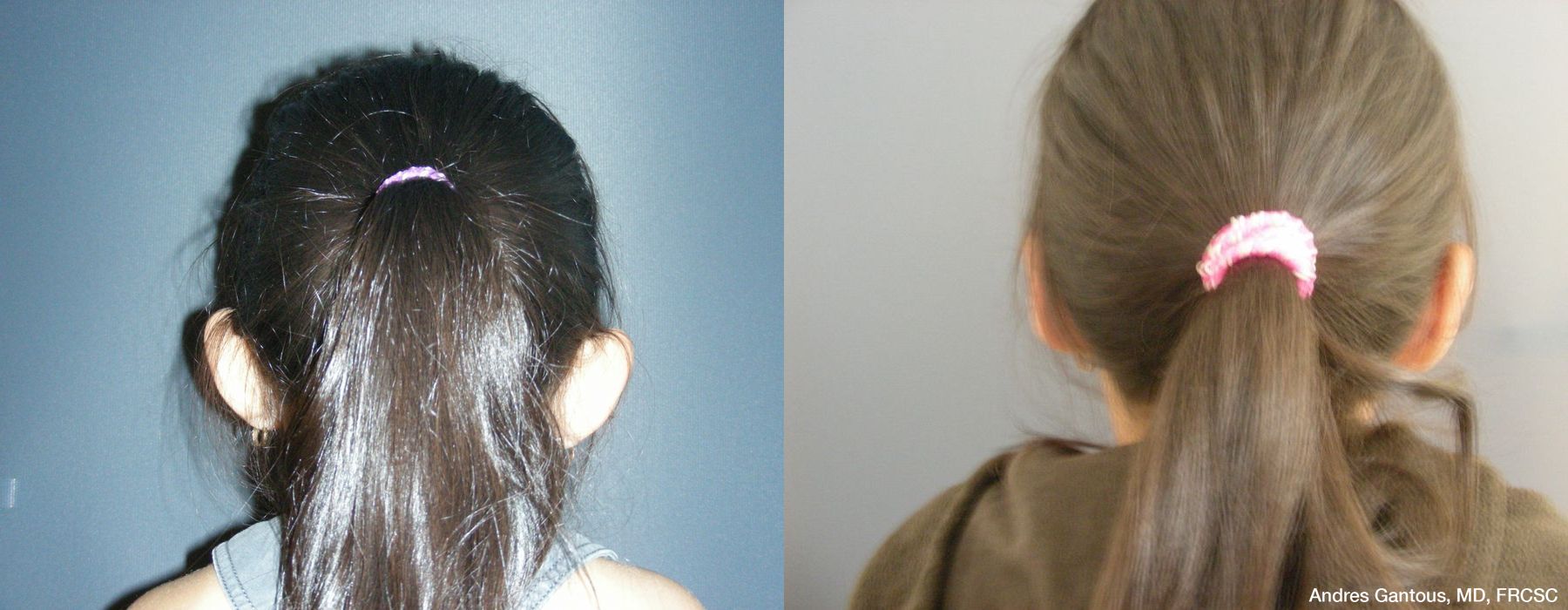 Otoplasty and Earlobe Repair - Thumbnail 6