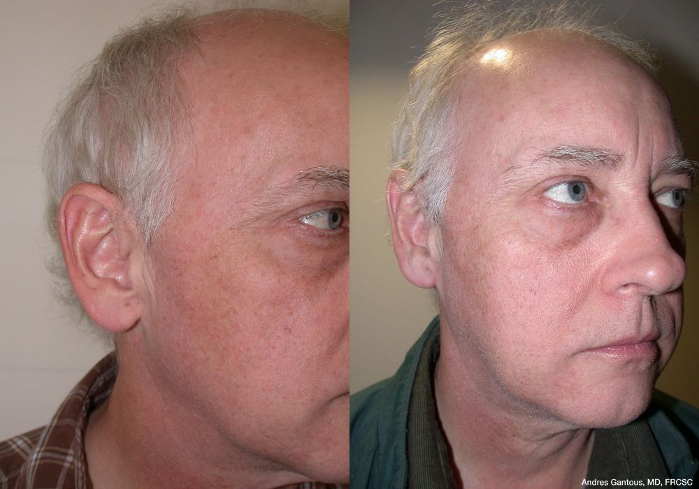 Before photo - Angle 2