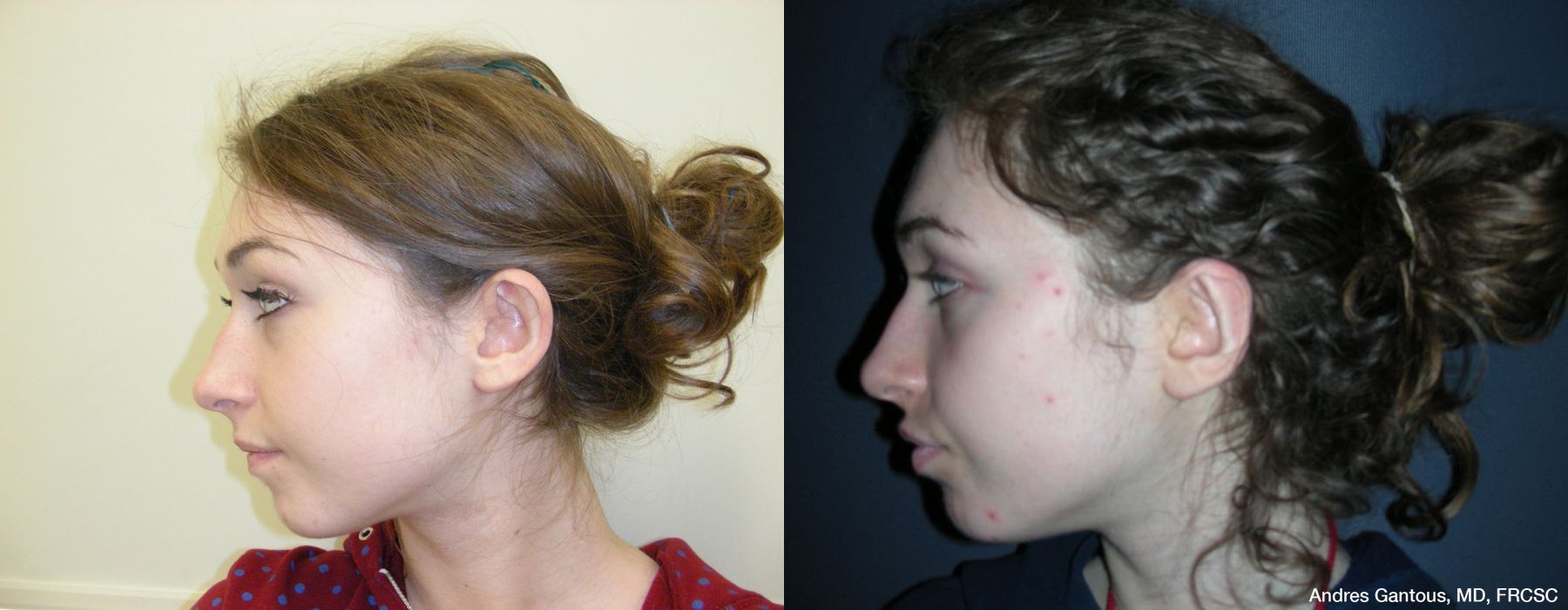 Otoplasty and Earlobe Repair - Thumbnail 5