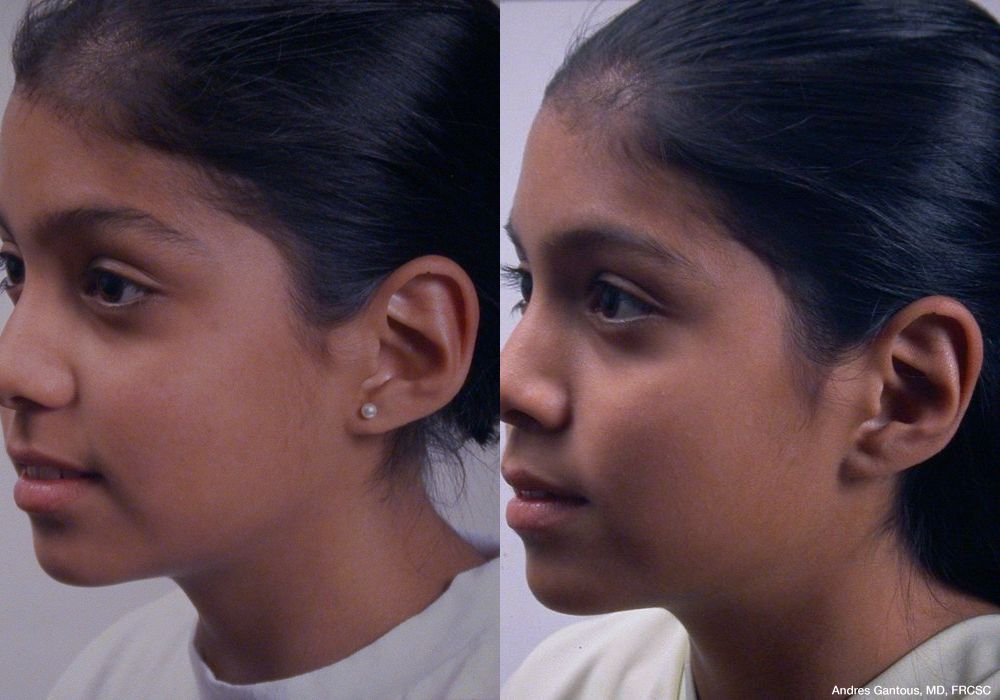 Otoplasty and Earlobe Repair - Thumbnail 4