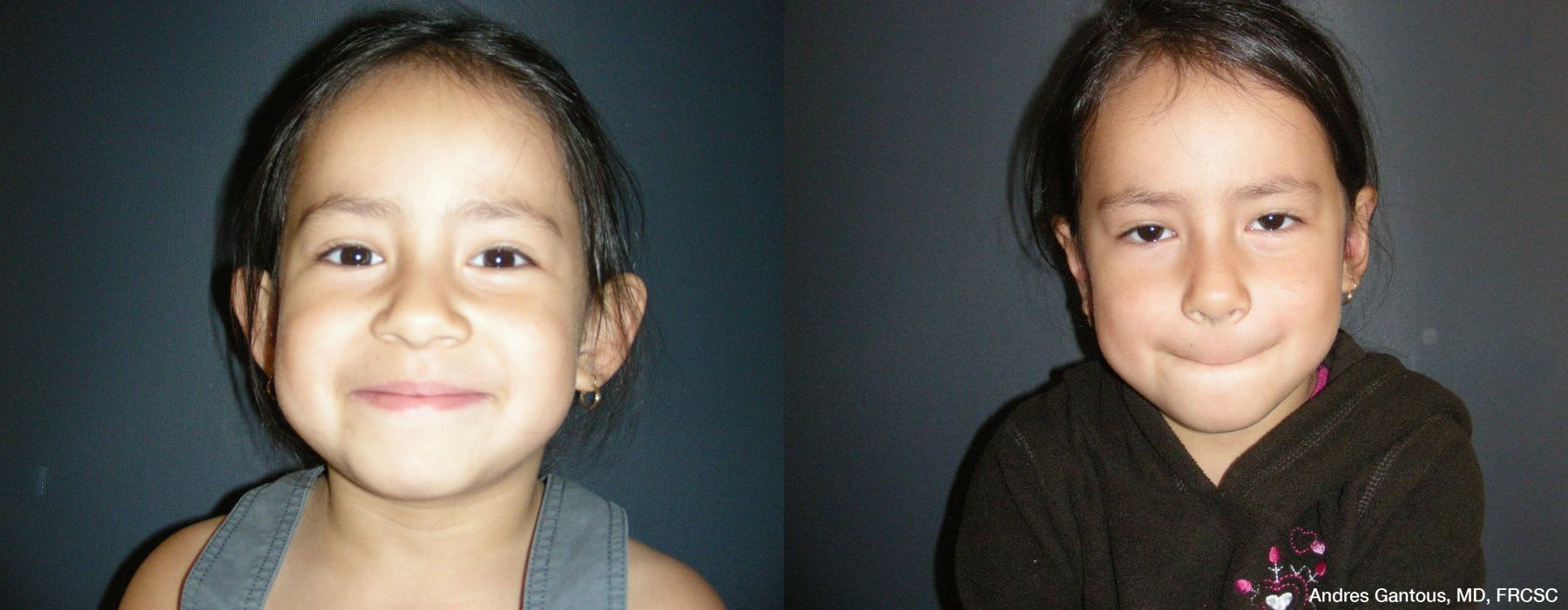 Otoplasty and Earlobe Repair - Case 6991