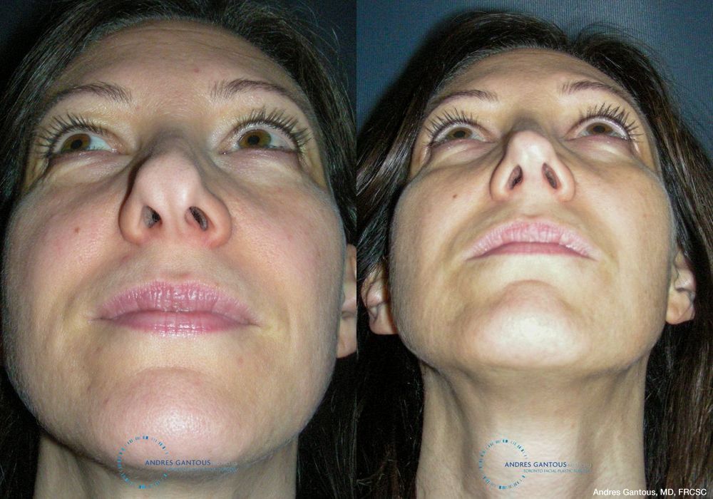 Revision Rhinoplasty - Thumbnail 2