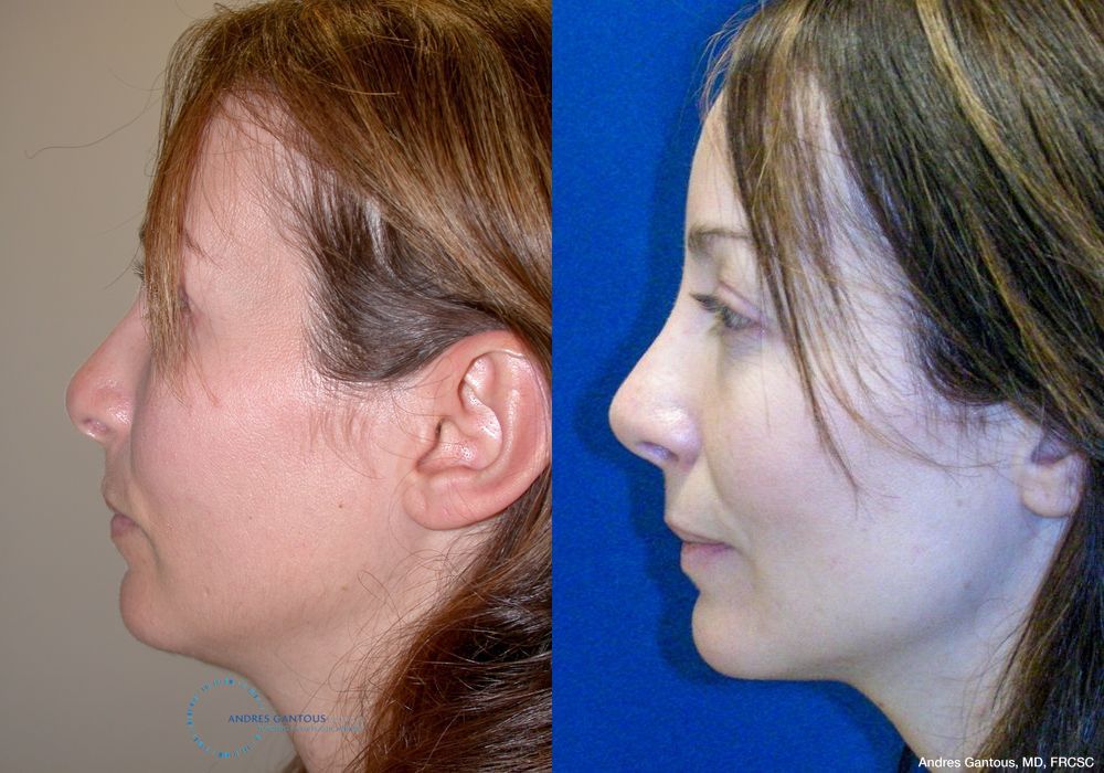 Revision Rhinoplasty - Thumbnail 5