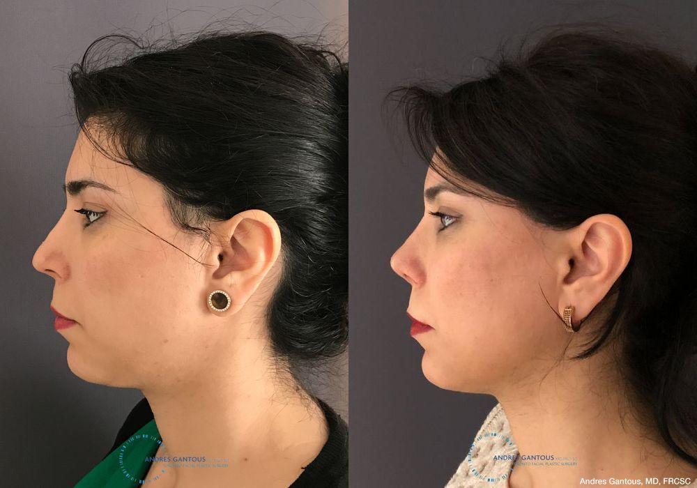 Revision Rhinoplasty - Thumbnail 6