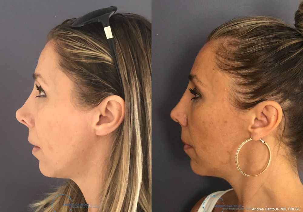 Revision Rhinoplasty - Thumbnail 6