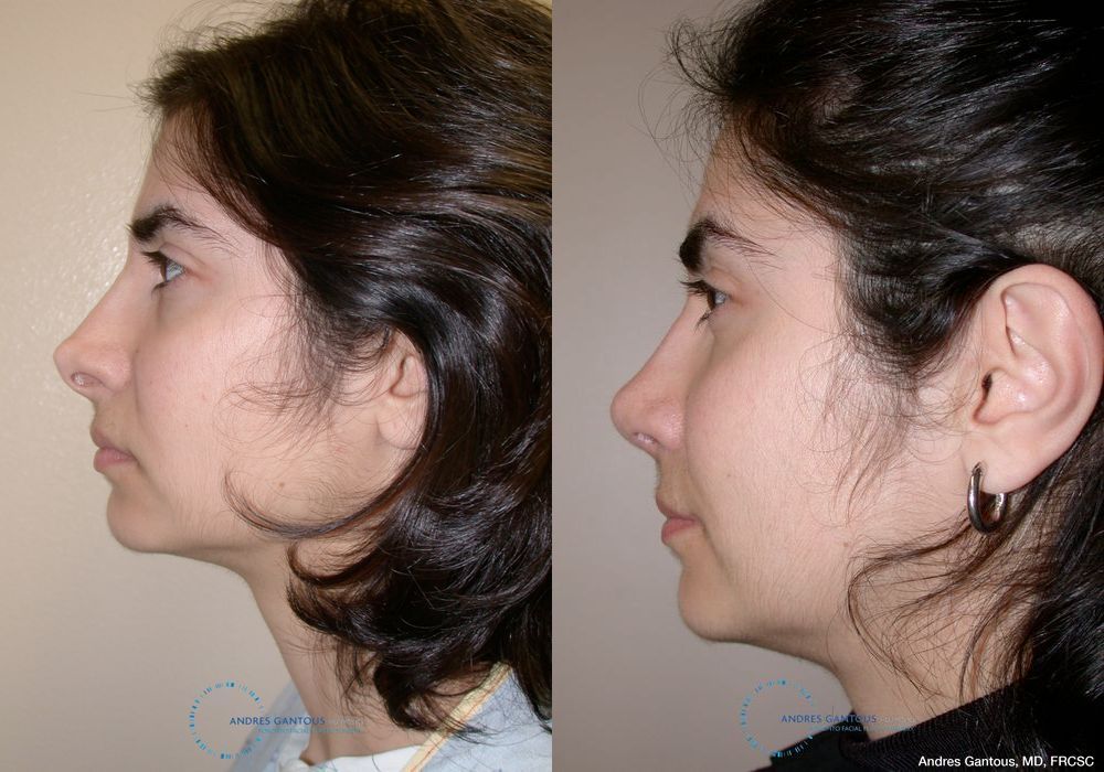 Revision Rhinoplasty - Thumbnail 5