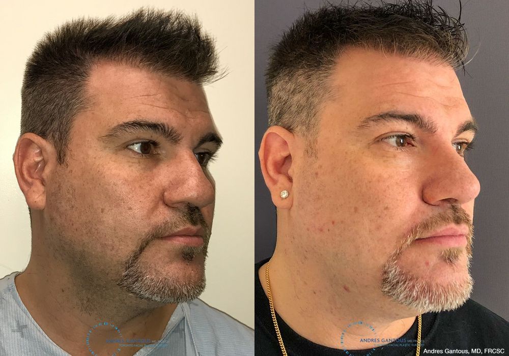 Revision Rhinoplasty - Thumbnail 4