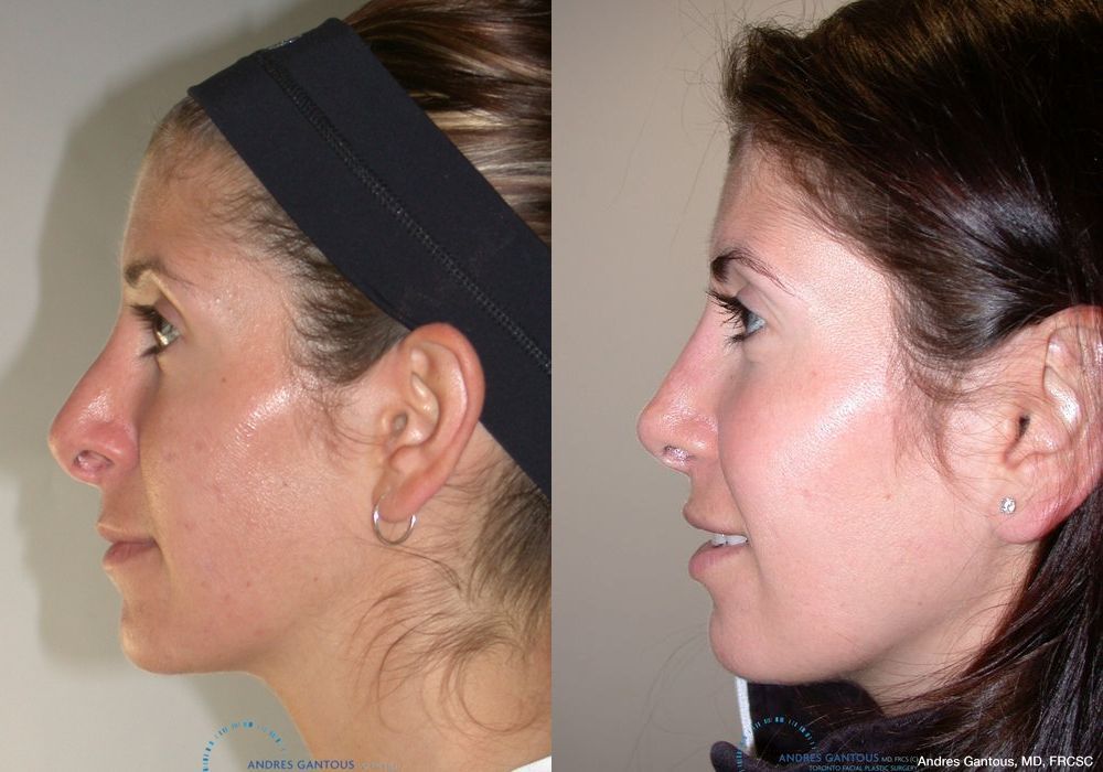 Revision Rhinoplasty - Thumbnail 4