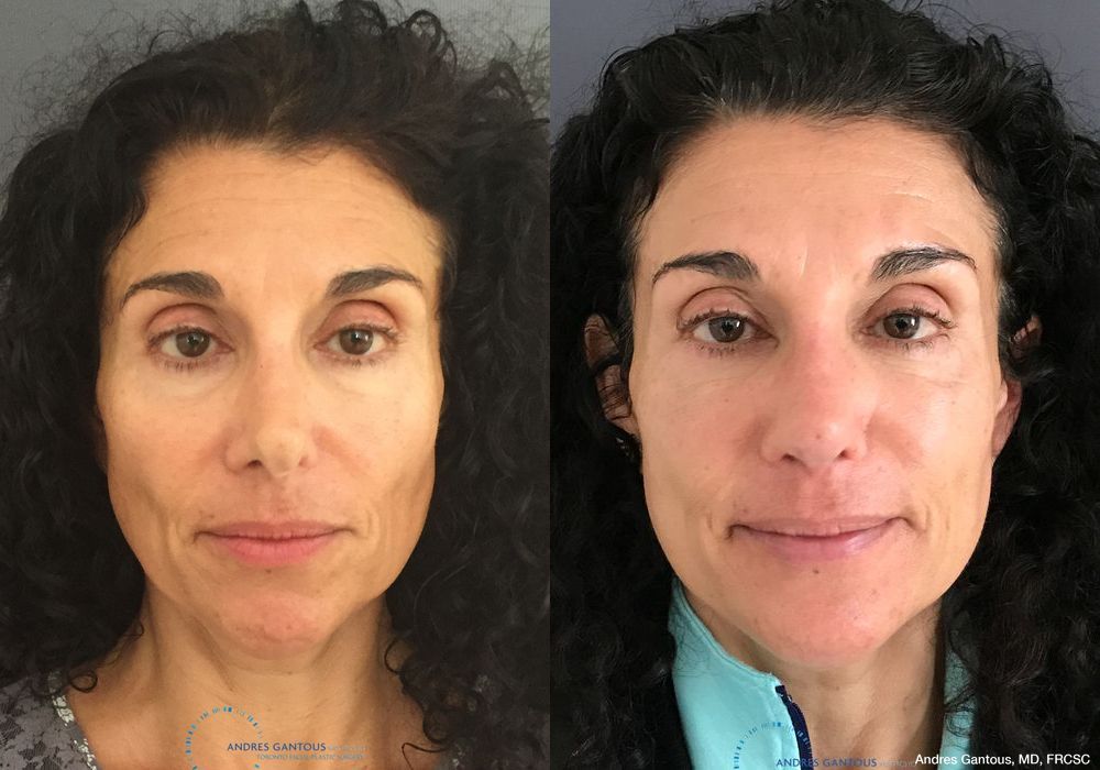 Revision Rhinoplasty - Case 6644