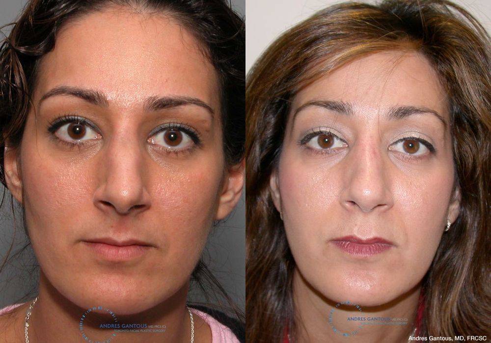 Revision Rhinoplasty - Case 6653