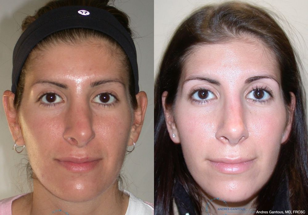 Revision Rhinoplasty - Case 6639