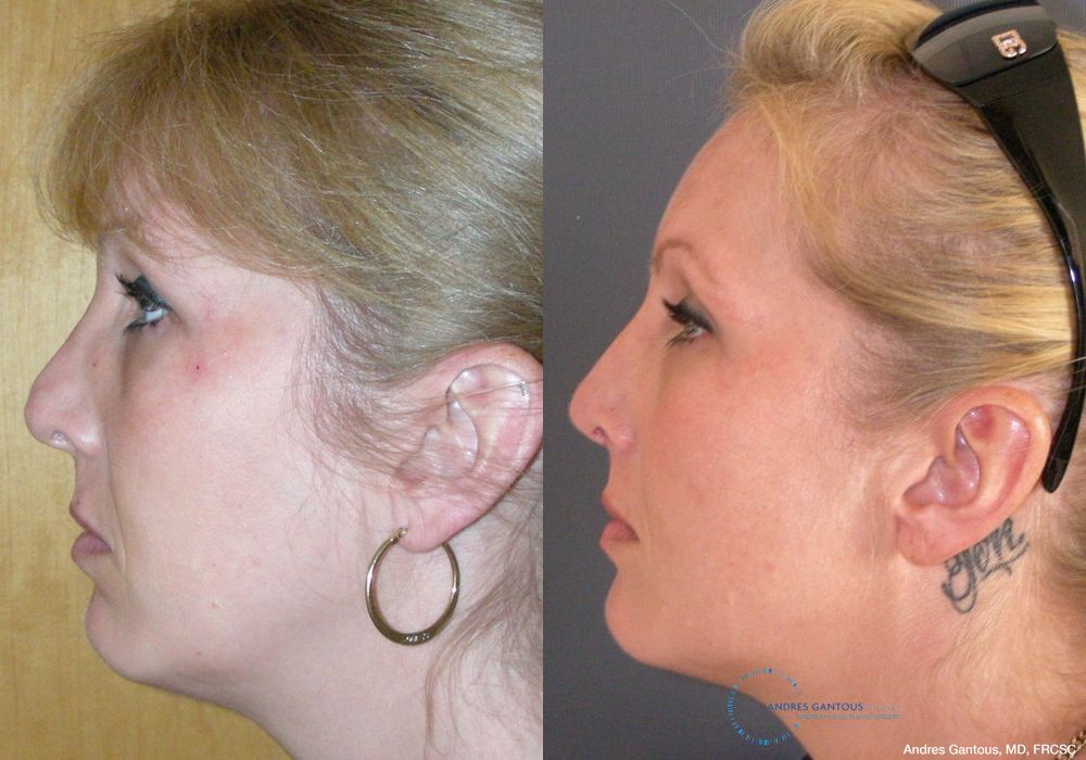 Revision Rhinoplasty - Thumbnail 6
