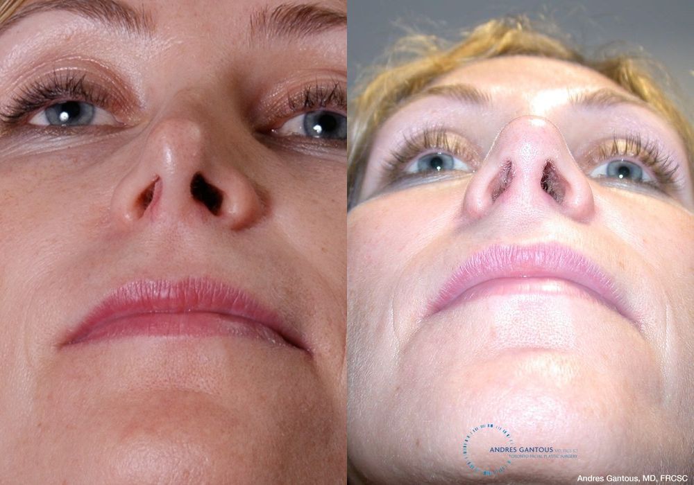 Revision Rhinoplasty - Thumbnail 2