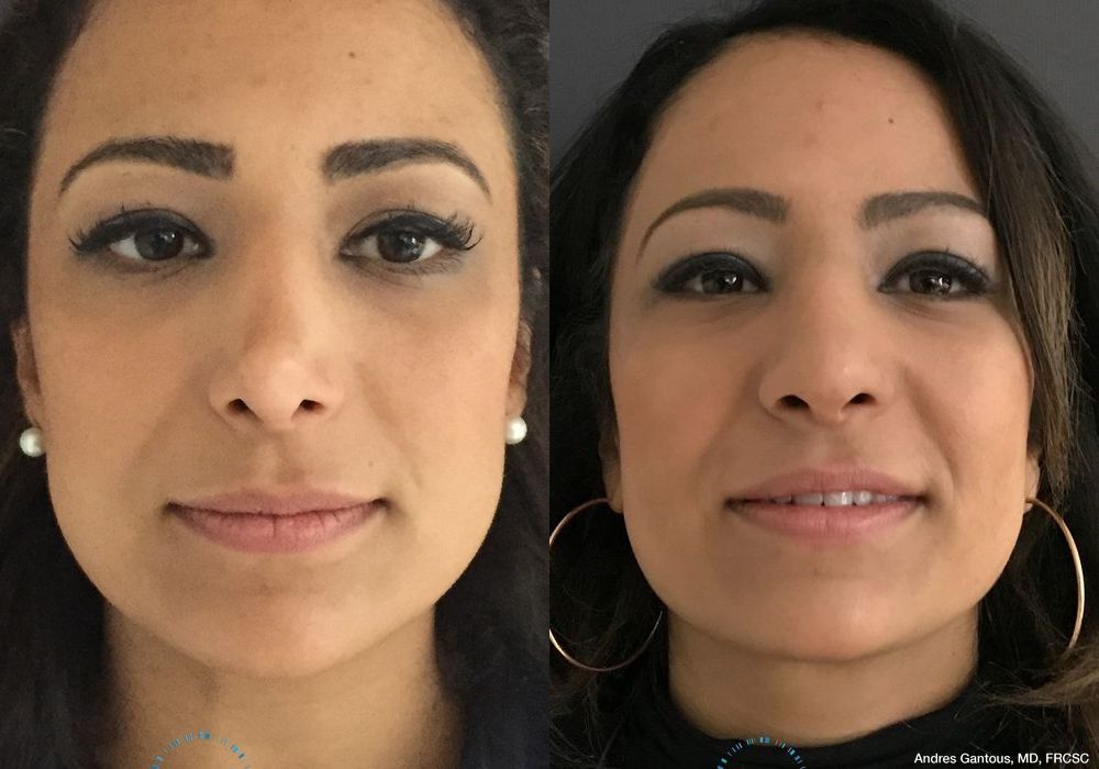 Revision Rhinoplasty - Case 7070