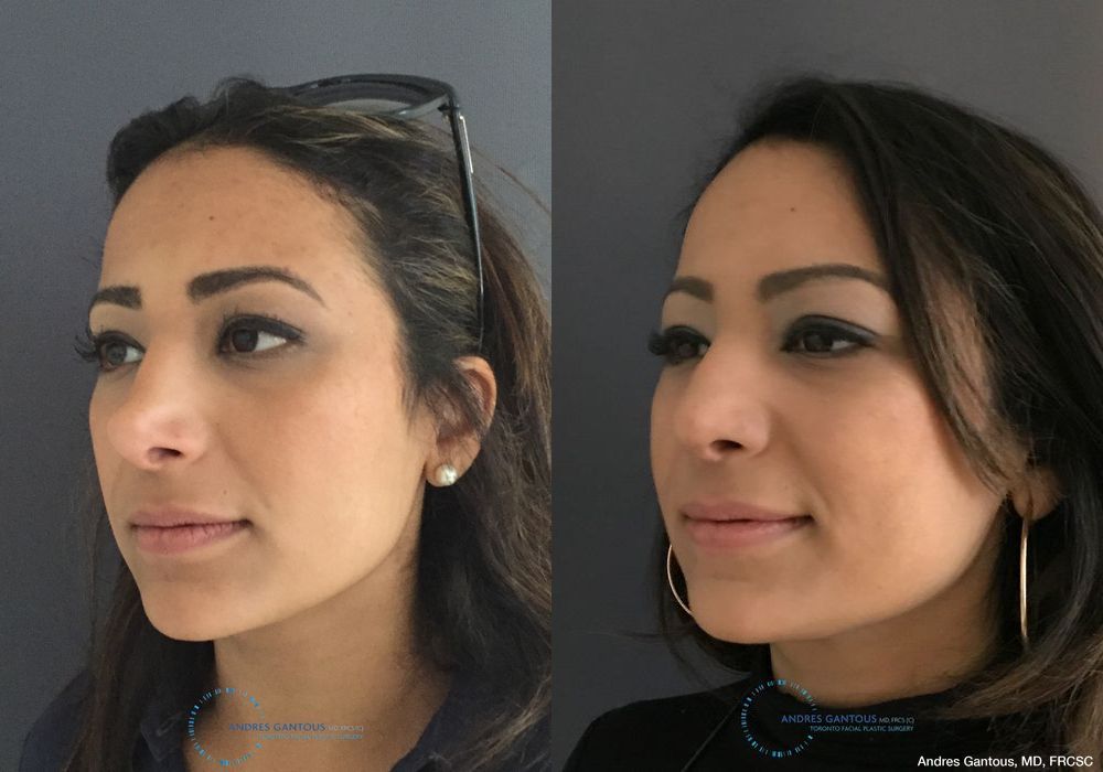 Revision Rhinoplasty - Thumbnail 4