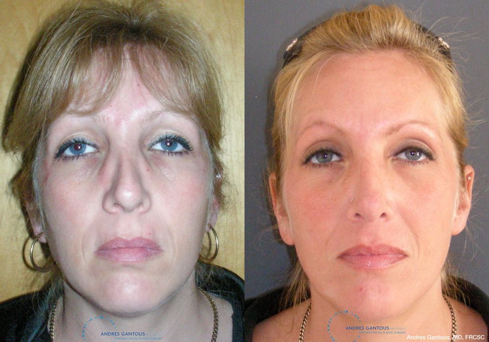 Revision Rhinoplasty - Case 6652