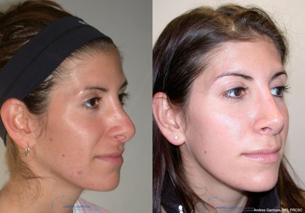 Revision Rhinoplasty - Thumbnail 2